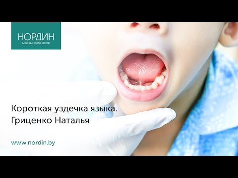 Видео: Короткая уздечка языка у ребёнка, что делать?