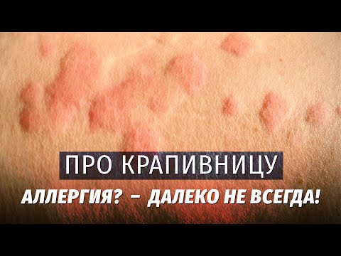 Видео: Про крапивницу. Теория и лайфхаки. Аллергия? - Далеко не всегда!!