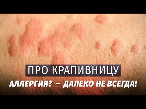 Видео: Про крапивницу. Теория и лайфхаки. Аллергия? - Далеко не всегда!!