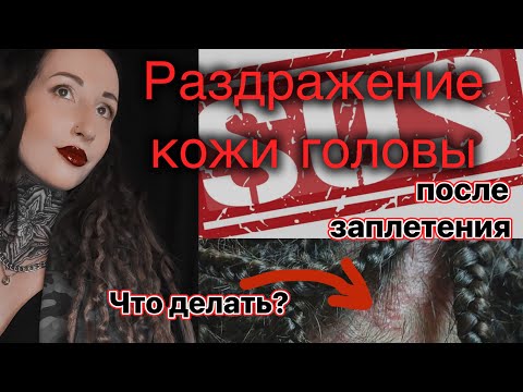 Видео: РАЗДРАЖЕНИЕ КОЖИ ГОЛОВЫ после заплетения кос и дредов: как его убрать? Причины раздражения