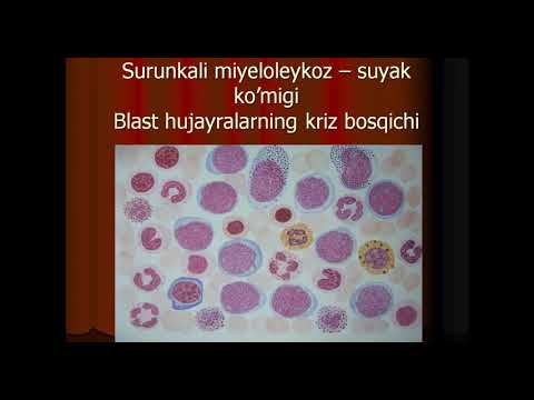 Видео: Лейкоцитлар патофизиологияси  Лейкоцитоз, лейкемия, лейкозлар