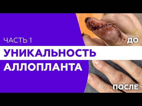 Видео: Уникальность биоматериала АЛЛОПЛАНТ