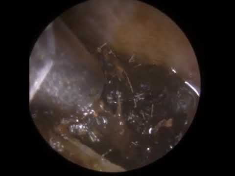 Видео: 851 - Удаление сильно заложенных ушей серы