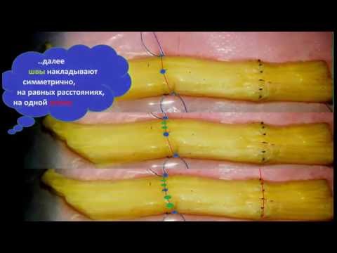 Видео: шов нерва