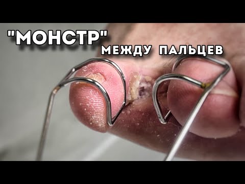 Видео: Межпальцевый нарост, мягкий и болезненный.