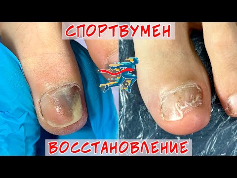 Видео: Восстановление ногтя после травмы / Онихолизис ногтей