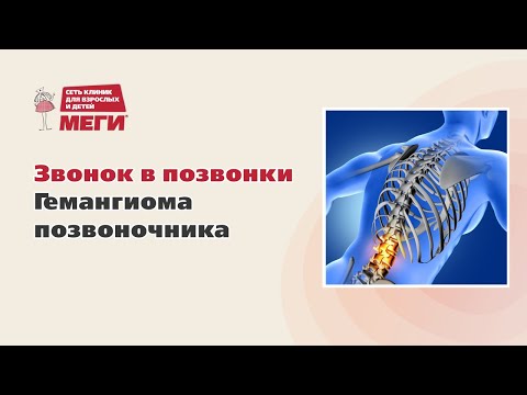Видео: Звонок в позвонки — гемангиома позвоночника. Азат Амирович Зайнагов.
