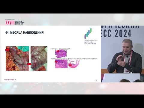 Видео: Неоадъювантная иммунотерапия при MSI раке желудка