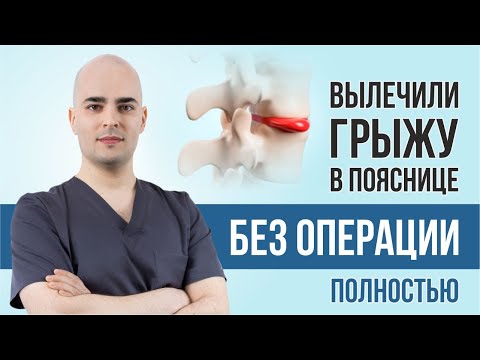 Видео: Как ПОЛНОСТЬЮ вылечили грыжу позвоночника в ПОЯСНИЦЕ. Разбор МРТ. Резорбция грыжи диска в пояснице.
