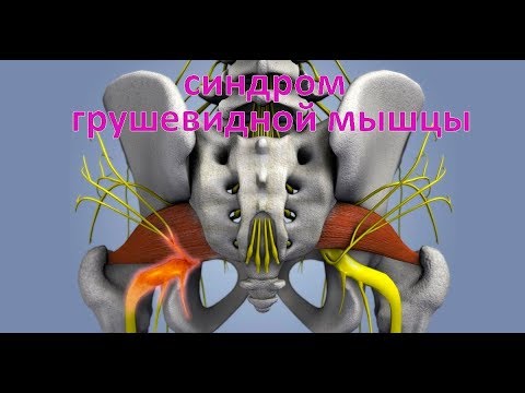 Видео: синдром грушевидной мышцы