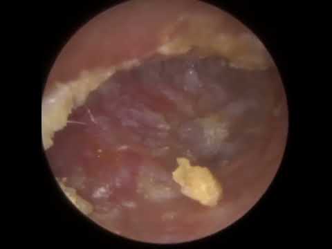 Видео: 885 - Болезненное удаление обтурирующего кератоза, вызванного грибком