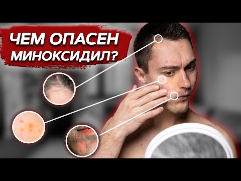 Видео: В чем ОПАСНОСТЬ миноксидила? / Что таится в составе миноксидила?