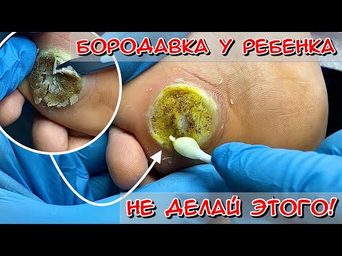 Видео: БОЛЬШАЯ БОРОДАВКА У РЕБЕНКА. КАК УБРАТЬ БОРОДАВКУ? БОРОДАВКА НА СТОПЕ #алена_лаврентьева