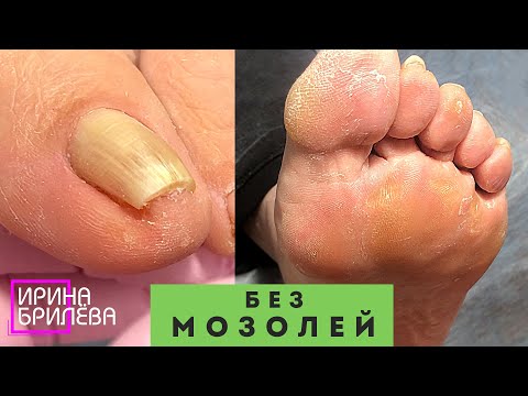 Видео: ПЕДИКЮР 🌸 Чтобы не болели пальцы и легче было ходить 🌸 Убираем подногтевые мозоли (Подробное видео)