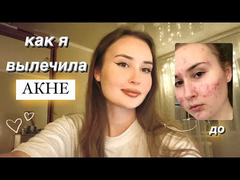 Видео: КАК Я ВЫЛЕЧИЛА АКНЕ?✨ гормоны, ретиноиды, таблетки и дерматологи 💊