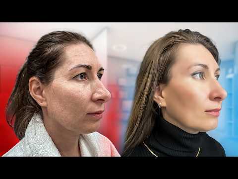 Видео: Как Сделать Эндоскопическую Подтяжку Лица, чтобы получить 100% результат [Осень 2025]