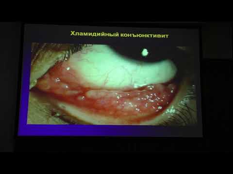 Видео: Хламидийный конъюнктивит - как дифференцировать и лечить?