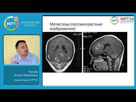 Видео: МРТ диагностика опухолей головного мозга