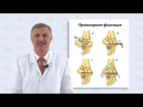 Видео: Перелом дистального отдела плечевой