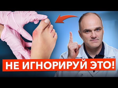 Видео: Правда о косточке на ноге, которую от вас скрывают ❌ Ортопед предупреждает!
