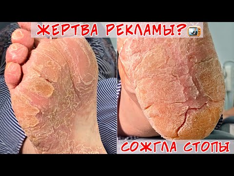 Видео: Трещины на пятках / Потрескалась кожа на ногах