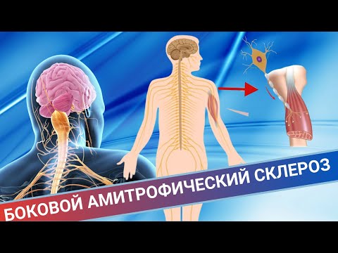 Видео: НОГИ ПЕРЕСТАЮТ СЛУШАТЬСЯ || Боковой амиотрофический склероз