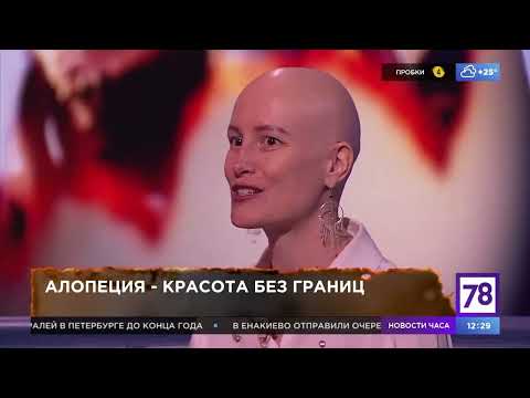 Видео: Мария Трухина. Личная история. Гнездная Алопеция.