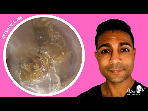 Видео: 1466 — повторное удаление ушной серы у 2 пациентов после нескольких неудачных попыток в других ме...