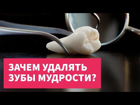 Видео: Зачем удалять зубы мудрости? Прямой эфир в Инстаграм