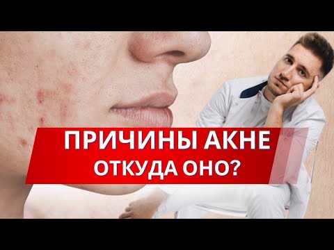Видео: Ищем причины акне! Откуда оно?