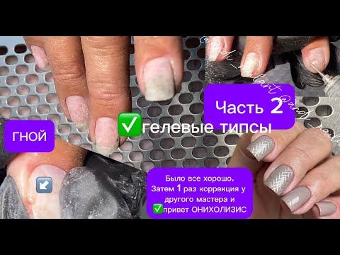 Видео: Сходила к другому мастеру ЧАСТЬ 2 ОНИХОЛИЗИС, ГНОЙ, гелевые типсы, протезирование и зачистка пустот