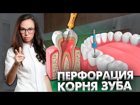 Видео: Перфорация корня зуба. Клинический случай