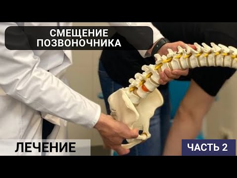 Видео: КАК ЛЕЧИТЬ СМЕЩЕНИЕ ПОЗВОНОЧНИКА? СПОНДИЛОЛИСТЕЗ (часть 2)