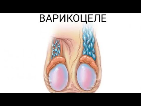 Видео: Варикоцеле, маьлумоти умуми дар бораи бемории васеьшавии варидхои органхои моядон.