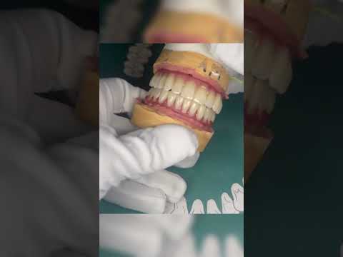 Видео: #dentist #виниры