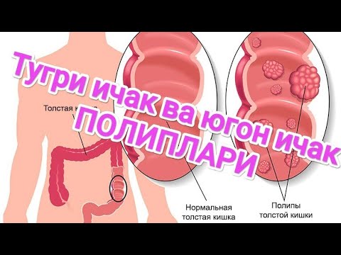 Видео: Тугри ичак ва югон ичак Хавфсиз усмаси-ПОЛИПЛАР. Куриниш геморройга ухшаш аммо умуман бошка касаллик