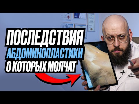 Видео: Эти последствия абдоминопластики умалчивают пациенты и хирурги