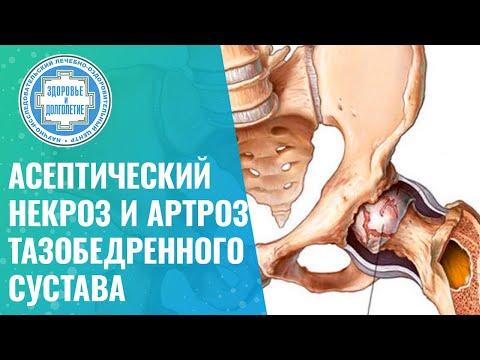 Видео: 👉 Асептический некроз головки бедренной кости и артроз тазобедренного сустава