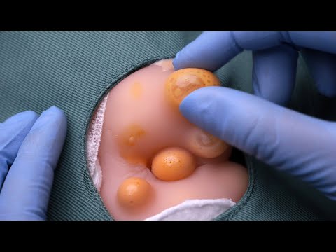 Видео: [ASMR] Хирургия проблемного пупка 👩‍⚕💉 (ролевая игра по лечению прыщей, субтитры, ACMP)
