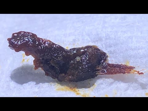 Видео: 866 - Удаление воспаленной ушной серы