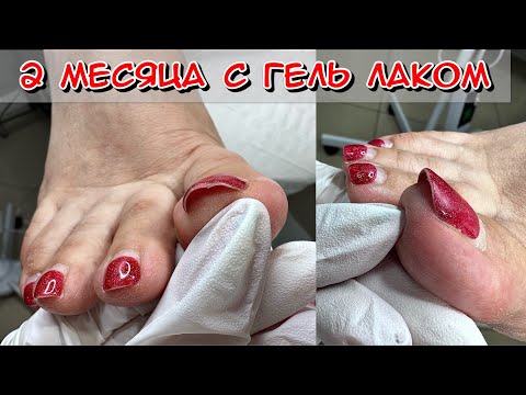 Видео: 2 месяца с гельлаком. Обработка пяток при педикюре. Трещины на пятках как убрать? Как делать педикюр