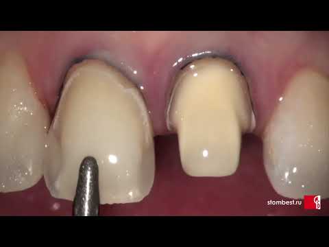 Видео: Снятие слепка для установки коронок. Анестезия,  ретракция десны.