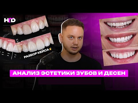 Видео: Анализ эстетики зубов и десен | PROвиниры Прокопович Виктор