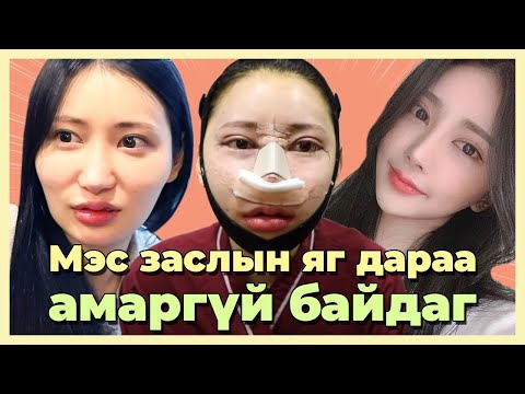 Видео: Нүүрний хэлбэр засах & Хамрын давтан & Давхраа хийлгэсний дараа яаж өөрчлөгдсөн бол??? [монгол хэл]