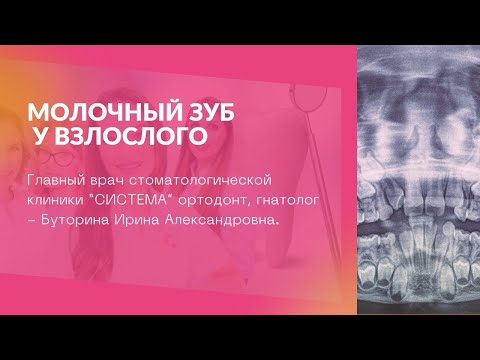 Видео: Ретенированный зуб, молочный зуб у взрослого