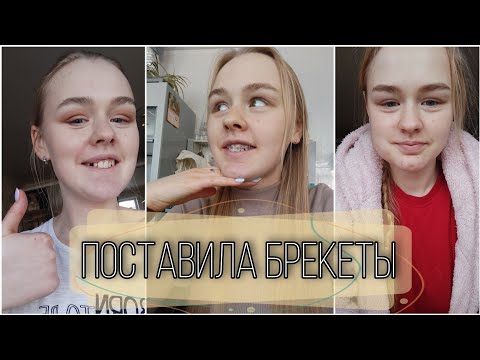 Видео: Поставила БРЕКЕТЫ! Подготовка и Удаление Зубов Мудрости