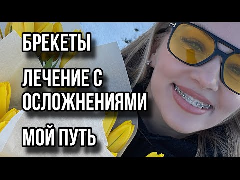 Видео: Брекеты. Лечение с осложнениями. Мой путь.
