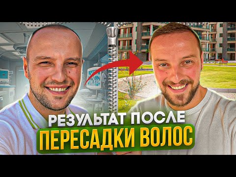 Видео: Пересадка волос на Северном Кипре | Личный опыт пересадки волос ДО и ПОСЛЕ