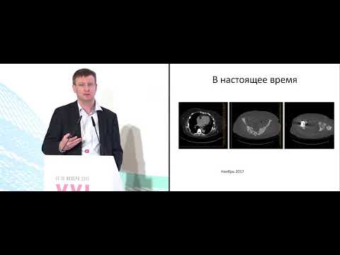 Видео: Как я лечу диссеминированный гормонозависимый рак молочной железы. Разбор клинического случая