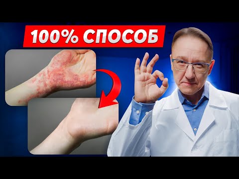 Видео: Как перестать страдать от экземы? Используй этот метод! 8 видов экземы!